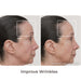 TheraFace Improved Wrinkles